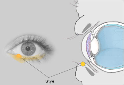 Bacterial Infections Of The Eyelid