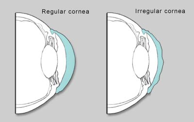 An astigmatic cornea is irregularly shaped, causing blurred or 