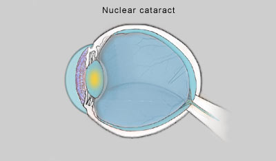 cortical cataract