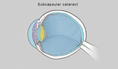 Subcapsular cataract steroid